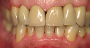 After Cosmetic Dentistry